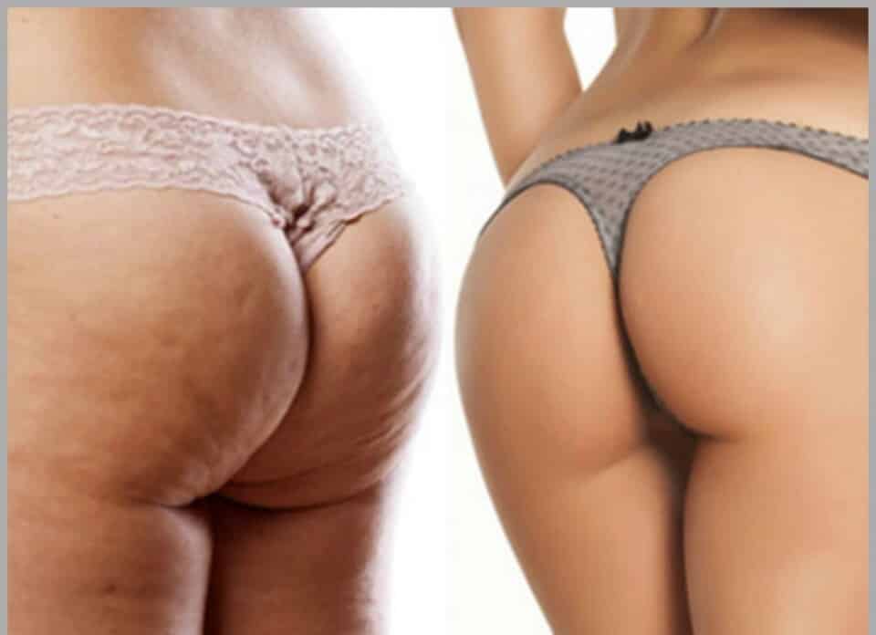 glutei